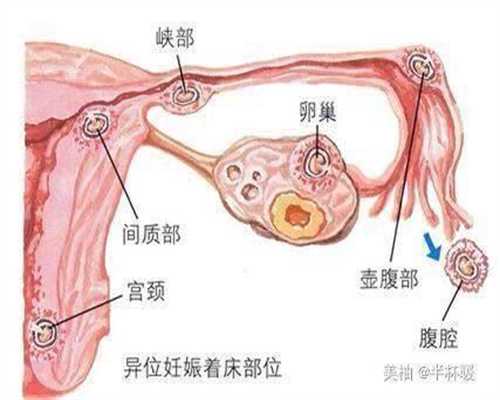 杭州哪家医院可以代孕_怀孕血糖高能吃菠萝吗
