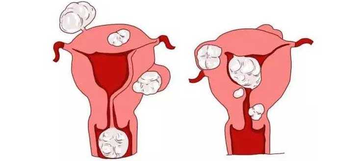 切除子宫卵巢怀孕_习惯性流产的预防_崇左45岁做试管婴儿检查发现子宫长了瘤