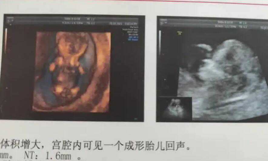 杭州360代怀孕公司 杭州市滨江医院试管婴儿患者评价 ‘三维b超单子怎么看男女